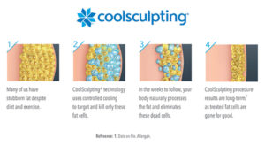 CoolSculpting Infographic